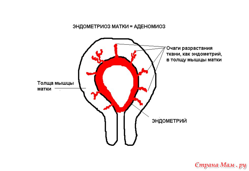 Структурные изменения матки. Эндометриоз аденомиоз матки.